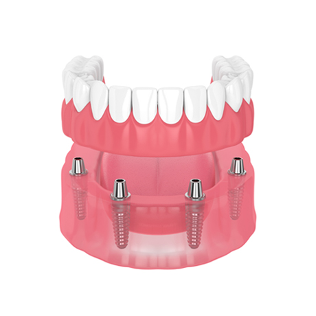 Full arch implants