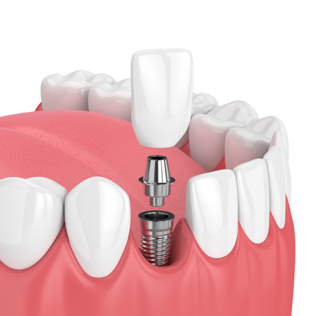 Single implant