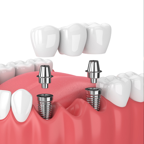 Implant-retained bridges