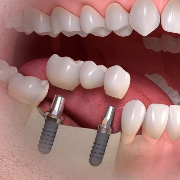 , What Are Dental Implants? Everything You Need to Know