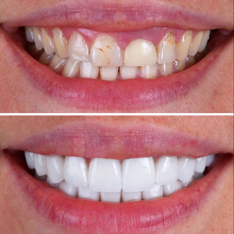 , Composite Bonding &ndash; A Fast Way to Improve Your Smile