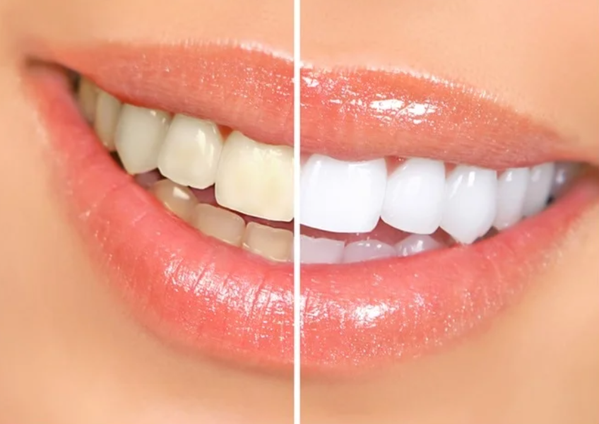 , Professional Teeth Whitening: A Safe Way to Brighten Your Smile