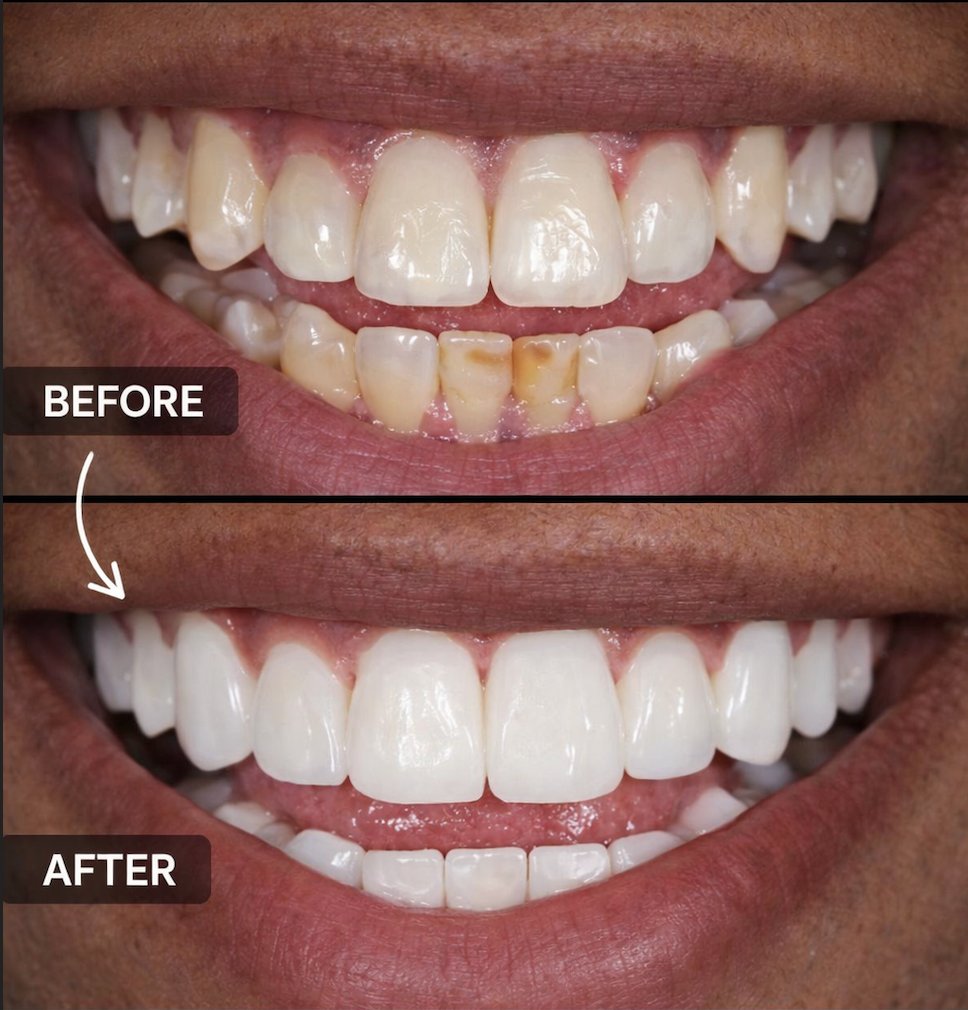 Teeth Cleaning Before And After Image
