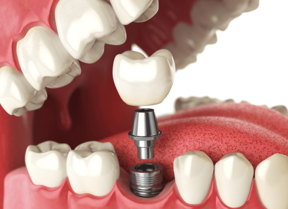 , Are Dental Implants Right For You?