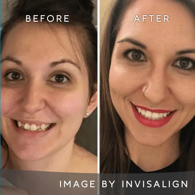 Before And After Image 1 Invisalign Aligners Edgware North London