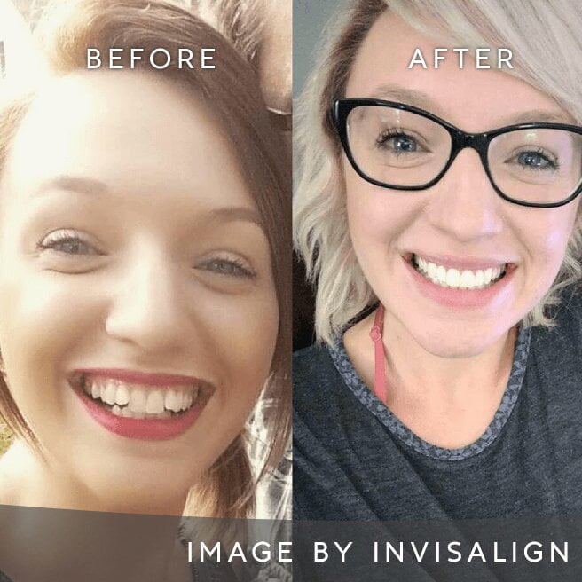 Before And After Image 2 Invisalign Aligners Edgware North London