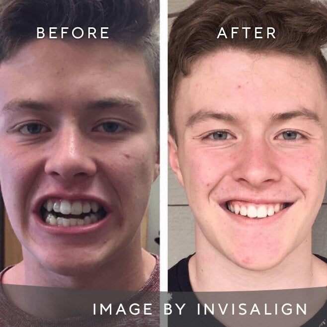 Before And After Image 3 Invisalign Aligners Edgware North London