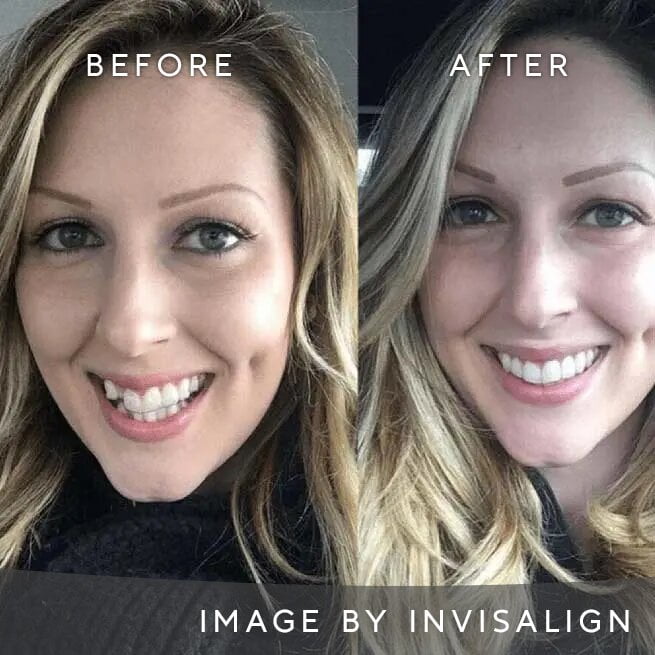 Before And After Image 4 Invisalign Aligners Edgware North London