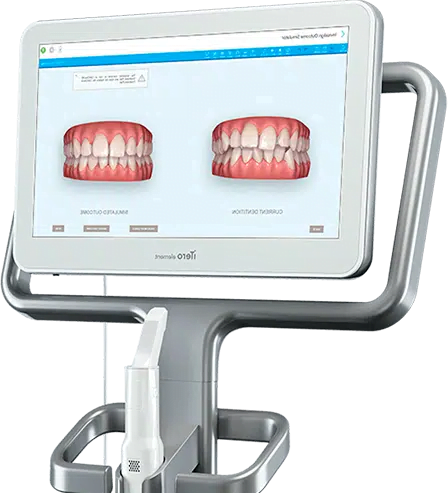 Itero Scan Invisalign Aligners Edgware North London