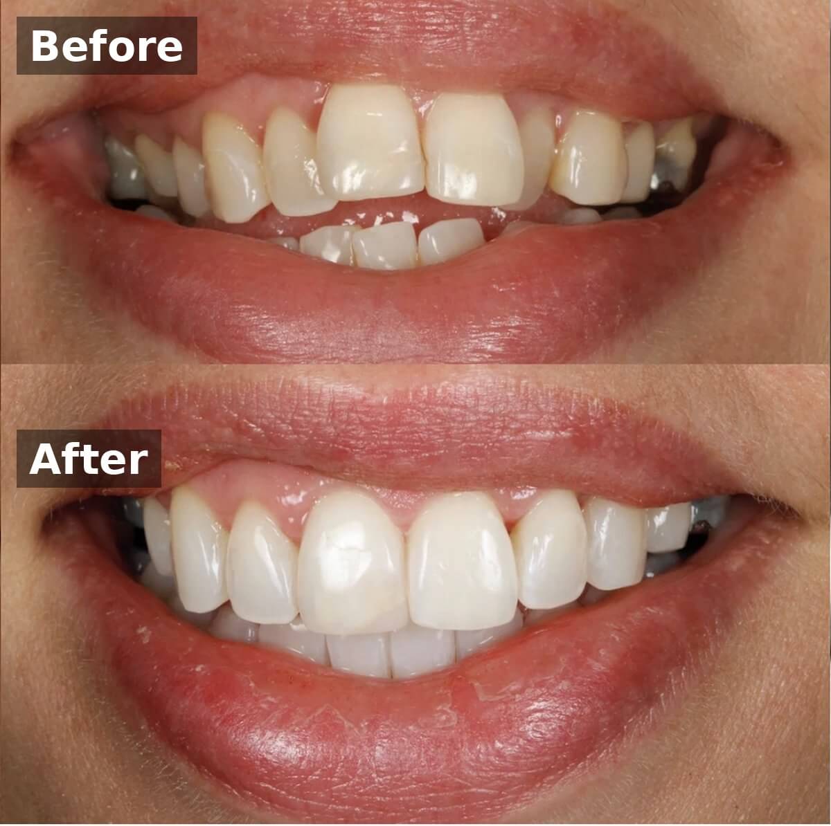 Invisalign Case B