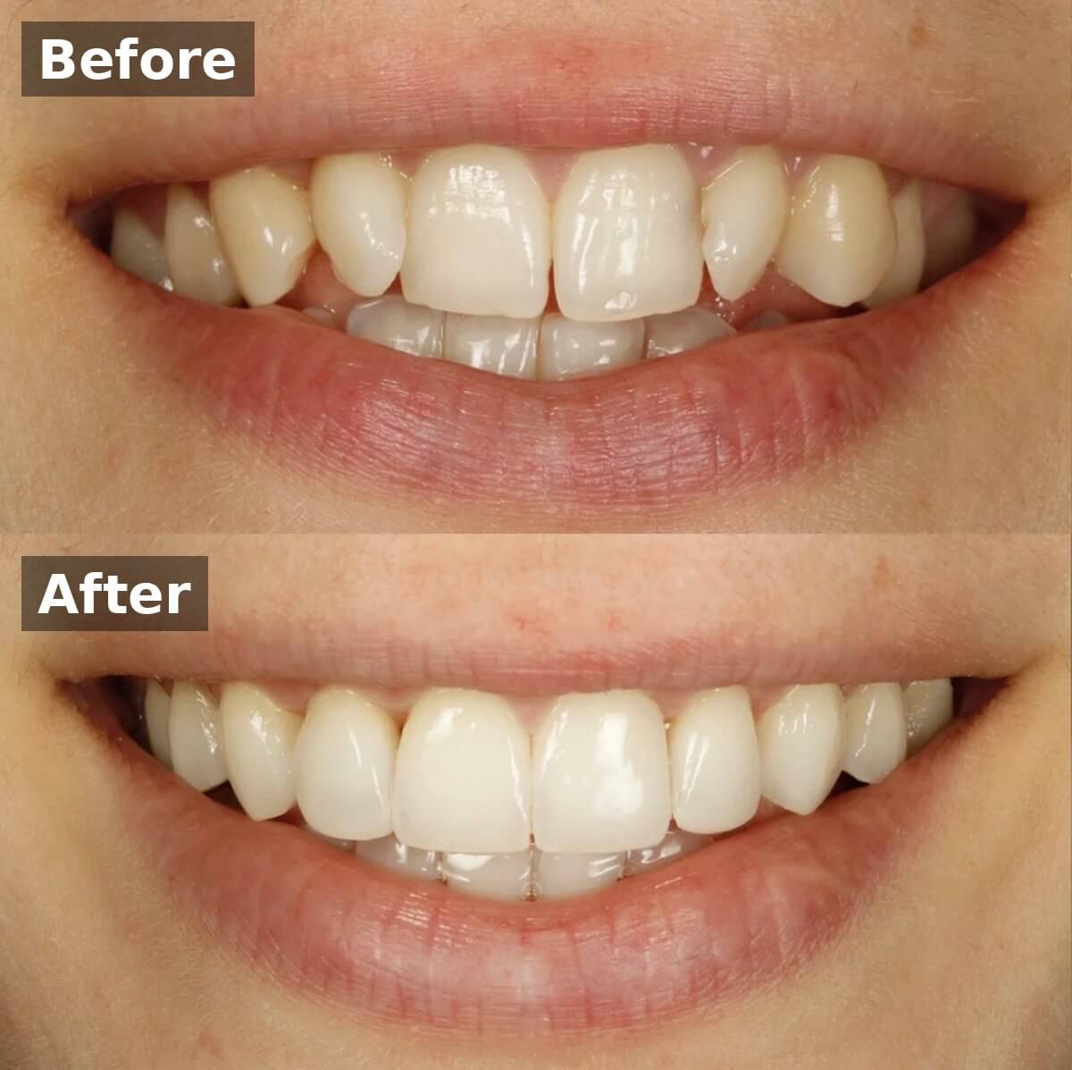 Invisalign Case E