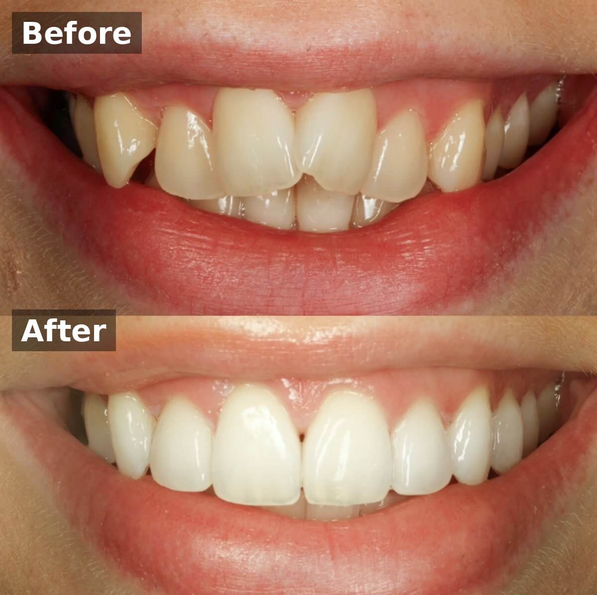 Invisalign Case G