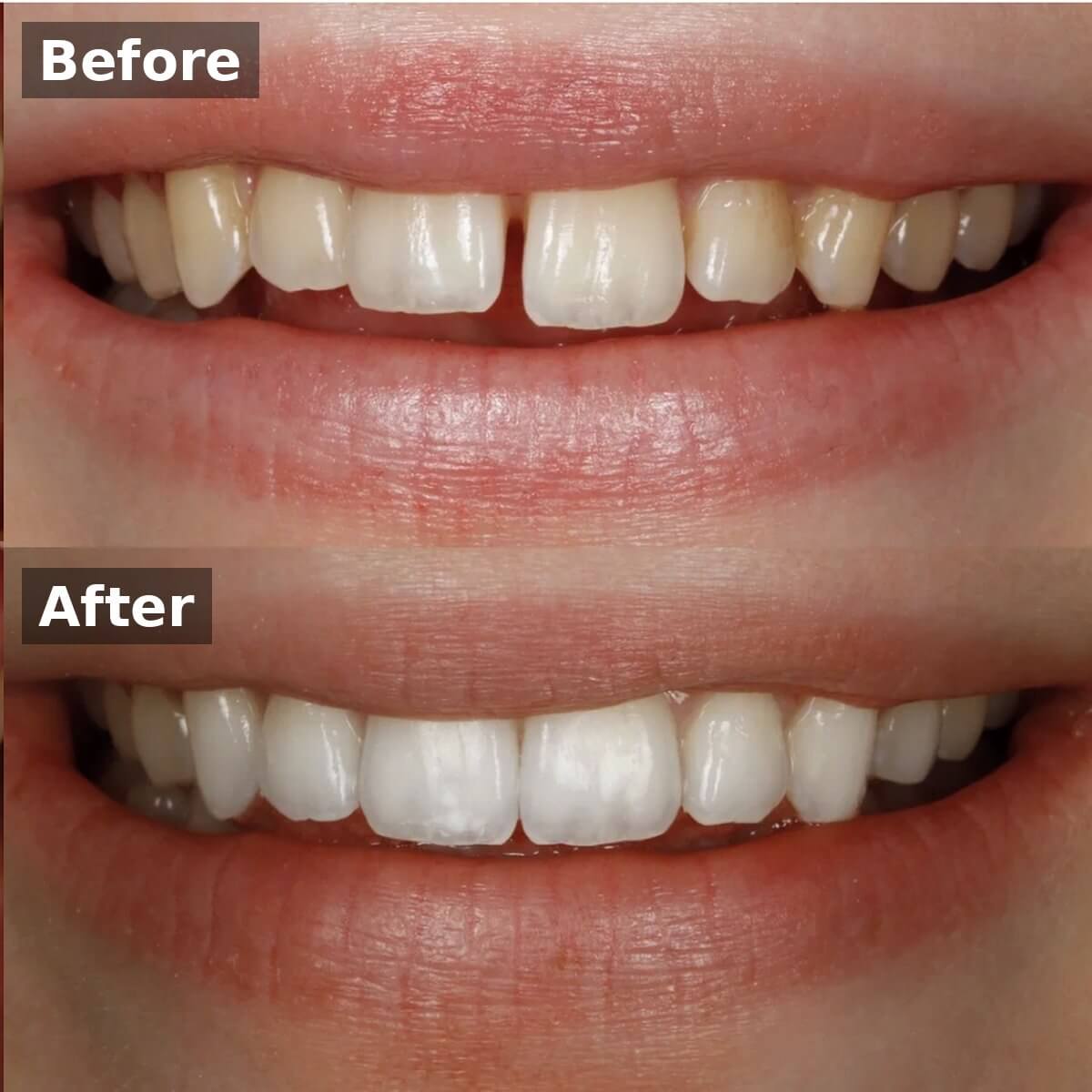Invisalign Case H